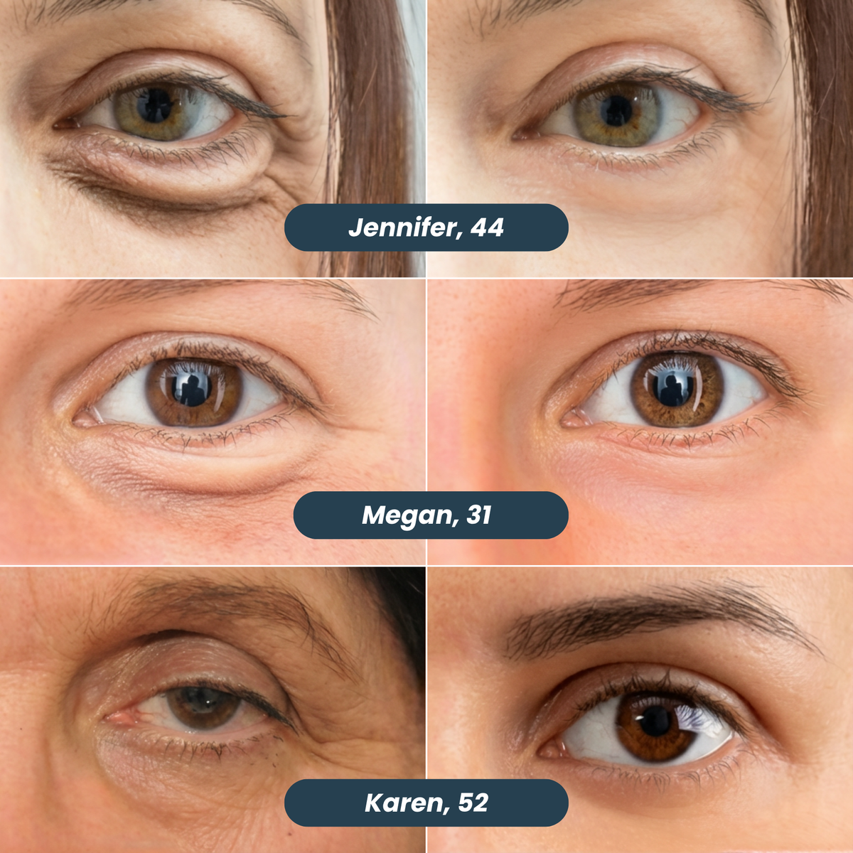Microneedle Patches | New Generation